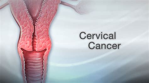 Can Hpv Warts Cause Cervical Cancer - CancerWalls