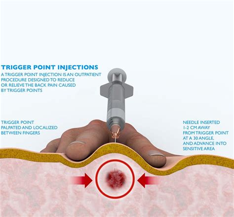 Trigger Point Injections - Dr. Sam | Personal Injury and Trauma ...