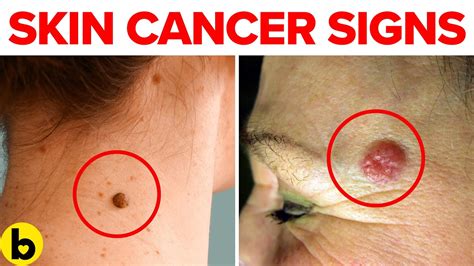 Skin Cancer Signs And Symptoms