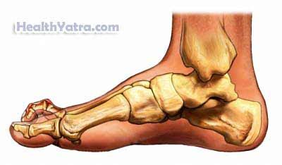 Pes Cavus Definition, Causes, Symptoms, Complications and Cost Surgery Treatment Hospital in India