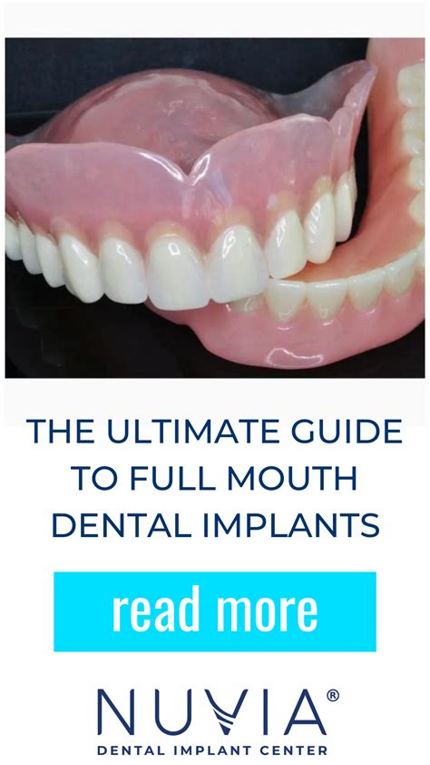 The Ultimate Guide To Full Mouth Dental Implants In 2022. Everything ...