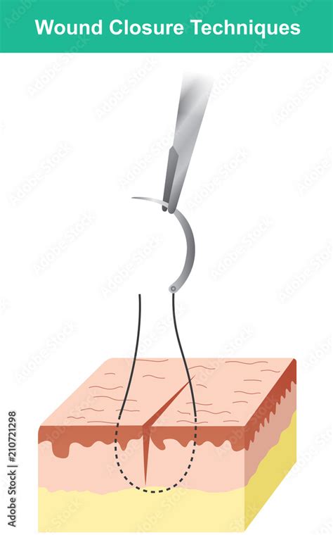 Wound closure techniques Isolate. Illustration infographic. Stock ...