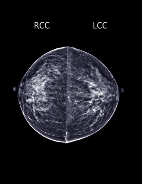 X-ray Digital Mammogram or Mammography Both Side of the Breast CC View ...