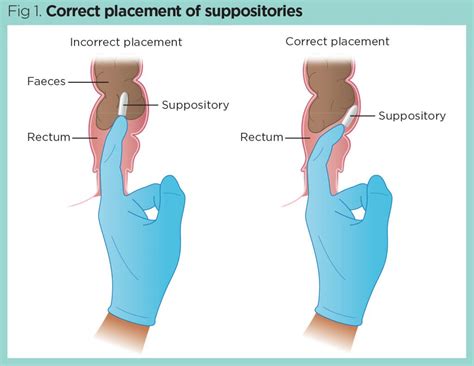 Overcoming barriers to nurses performing digital rectal examination | Nursing Times