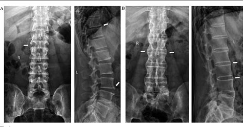 Figure 1 from The involvement of the spine in psoriatic arthritis. | Semantic Scholar