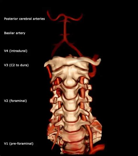 Vertebro-basilaire insufficiëntie: diagnose en klinische manifestatie ...