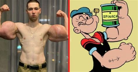 This Real-Life Popeye Has 3 Lbs Of Dead Muscle Removed From Biceps