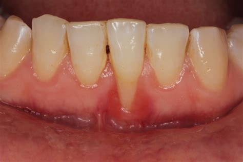 The Nature of Gingivitis and How to Prevent It - West Olds Dental