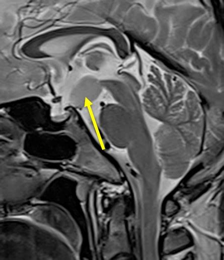 Hypothalamic hamartoma – Radiology Cases