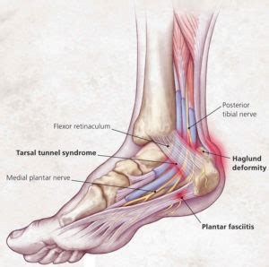 Heel pain causes, symptoms, diagnosis, pain relief & heel pain treatment