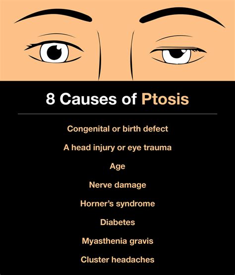 8 Causes of Ptosis and What You Can Do About It – The Amino Company