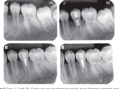 Structure of apical foramen of tooth | Semantic Scholar