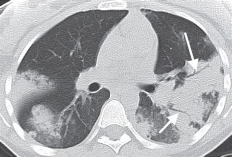 Signs and Patterns of Lung Disease | Radiology Key