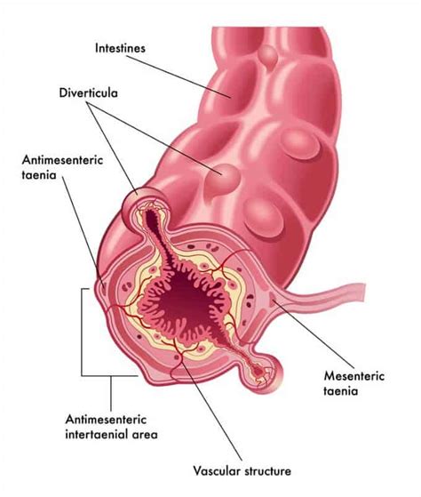 Diverticulitis Causes and How to Treat it Naturally - Holistic Health Herbalist