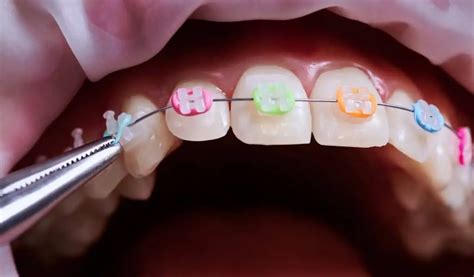 How Rubber Bands For Braces Help Align Your Teeth During Treatment ...