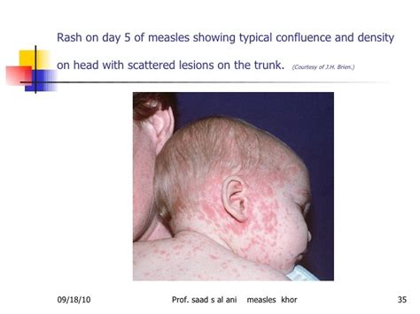 Measles