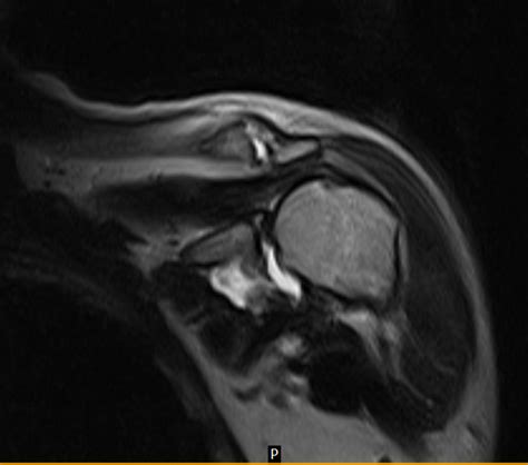 AC Joint Disruption MRI - Sumer's Radiology Blog