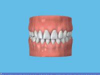 Fissure sealants - uSmile Dental Practice - Dentist in Porthcawl
