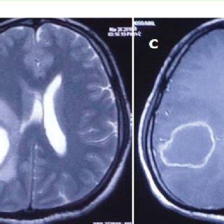 (a-c) T1-T2 weighted and post contrast T1 weighted MRI images showing... | Download Scientific ...