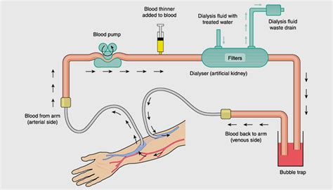 Different Types of Dialysis