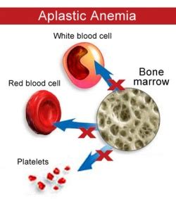 Aplastic anemia