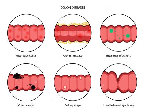 Premium Vector | Intestines diseases concept