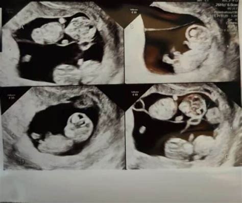 Jonathan and Mercedes Sandhus identical quadruplets ultrasound | Growing Your Baby