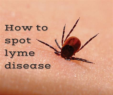 Beware the Tick Bite: Prevention and Early Signs you may have Lyme ...