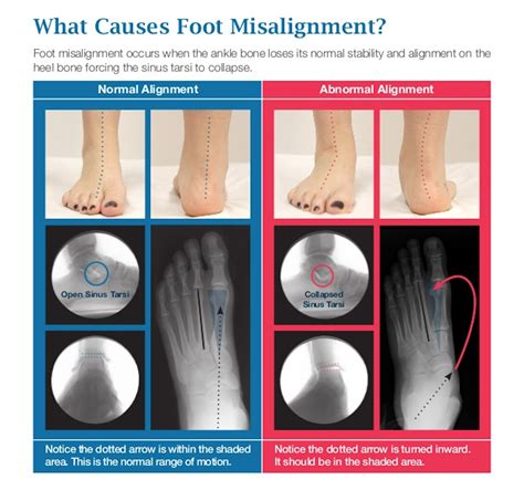 Everything You Need to Know about Misaligned Feet - Foot and Ankle Group