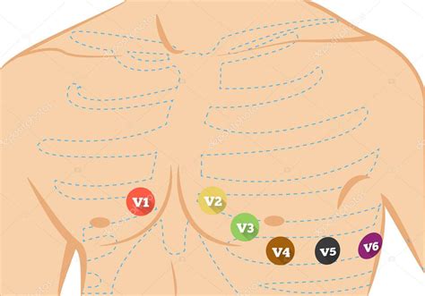 Chest ecg leads placement illustration. Six colored electrocardiography ...