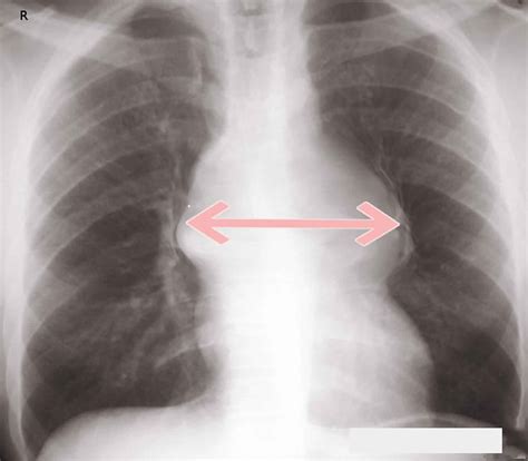 Mediastinum anatomy, location, cavity, organs, function & tumors