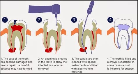 FAQs about Root Canal Treatment