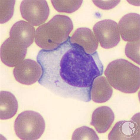 Reactive lymphocyte