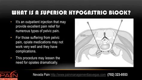 Superior Hypogastric Plexus Block Explained by a Las Vegas Pain Center (702) 323-0553 - YouTube