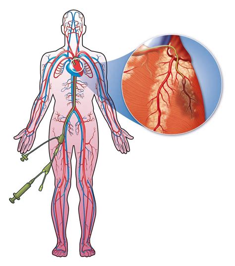 Cardiac Catheterization | Atlantic Cardiology, LLC