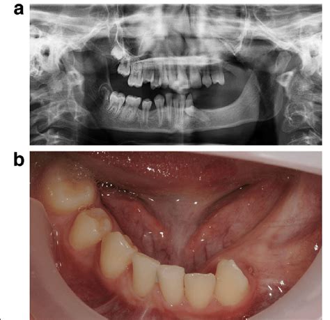 a Patient 2—pre-implant orthopantomogram (OPG) at the age of 12.... | Download Scientific Diagram