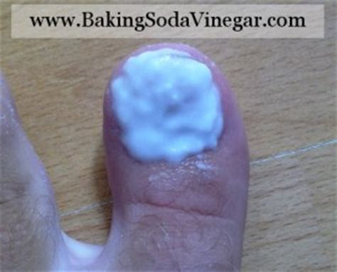 Toenail Fungus Treatment | Baking Soda and Vinegar Uses