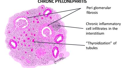 CHRONIC PYELONEPHRITIS - Pathology Made Simple