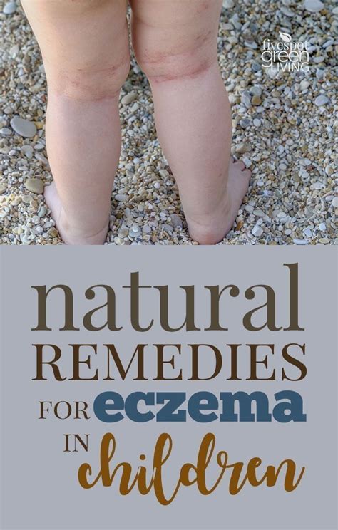 #Natural Remedies for Eczema in Children that clear it up quickly and completely… | Home ...