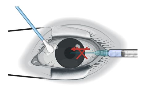 How to perform an AC tap - EyeGuru