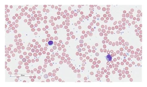 Peripheral smear showing leukoerythroblastosis and thrombocytosis ...