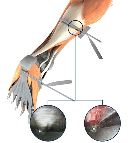 Endoscopic Gastrocnemius Recession (EGR) | Trice Medical