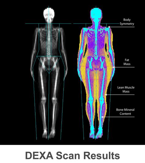 Dxa Scan Results