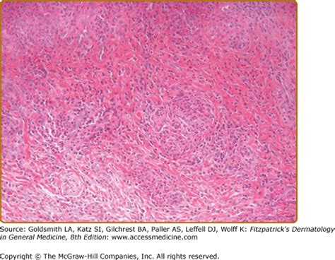 Erythema Elevatum Diutinum | Plastic Surgery Key