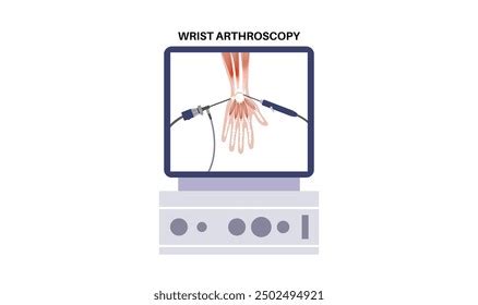 Wrist Arthroscopy Surgery Minimal Invasive Procedure Stock Vector (Royalty Free) 2502494921 ...