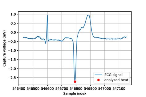 Illustrative ECG signal except of a premature ventricular contraction ...