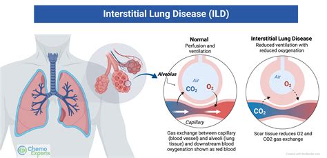 Interstitial Lung Disease | ChemoExperts