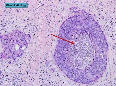 Qiao's Pathology: Invasive Ductal Carcinoma of the Breast with Central Necrosis Closely ...