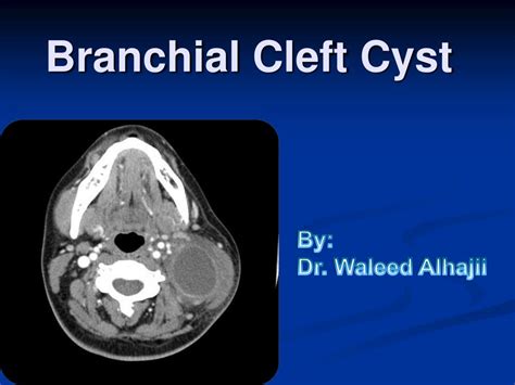 PPT - Branchial Cleft Cyst PowerPoint Presentation - ID:261469