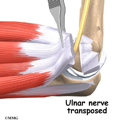 Ulnar Nerve: Cubital Tunnel Syndrome | Houston Methodist